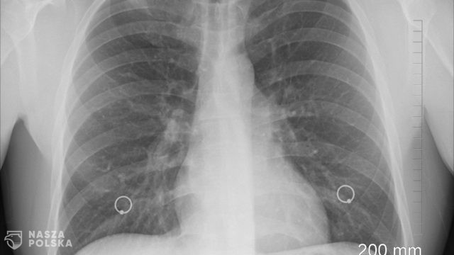 Eksperci: podczas pandemii niemal zaprzestaliśmy diagnozowania raka płuca